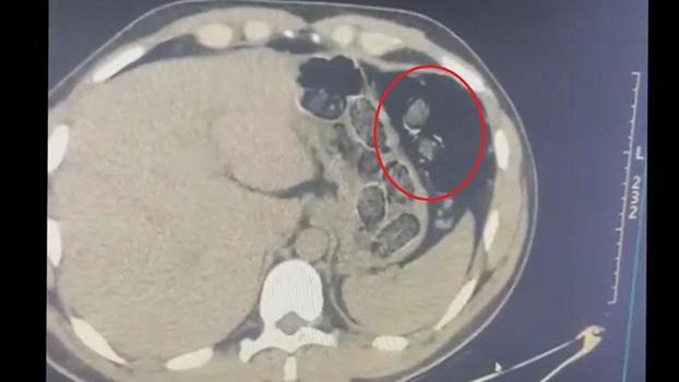 Midelerinden uyuşturucu taşıyan 2 şüpheli tutuklandı