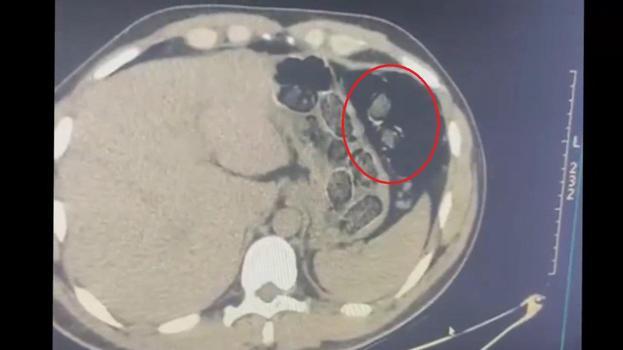 Midelerinden uyuşturucu taşıyan 2 şüpheli tutuklandı
