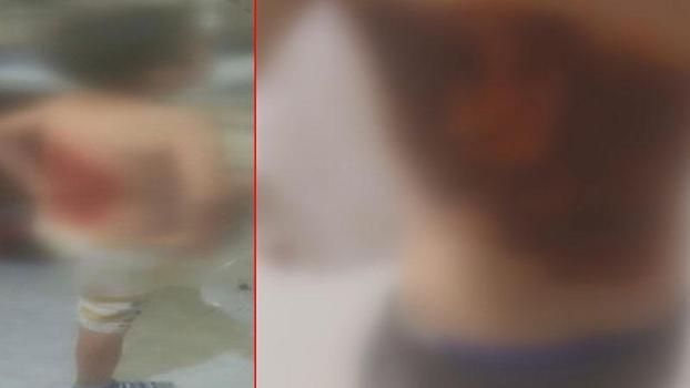 Arnavutköy’de arkadaşları tarafından kolonya dökülüp ateşe verilen 12 yaşındaki çocuk yaralandı
