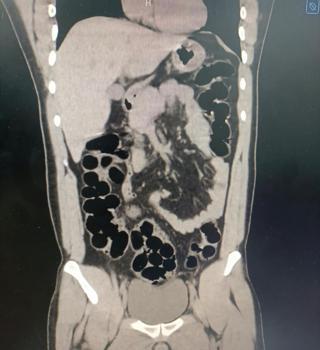 Midesinden kapsüller içinde 943 gram eroin çıktı