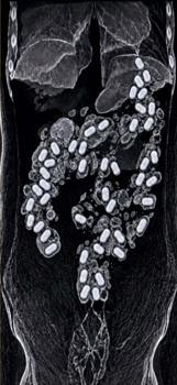 Havalimanında şüpheli yolcunun midesinden 322 gram metamfetamin çıktı