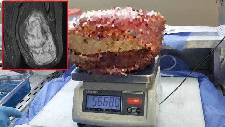 Diyarbakır’da, hastanın bacağından 5 kilo 668 gramlık kitle çıkarıldı