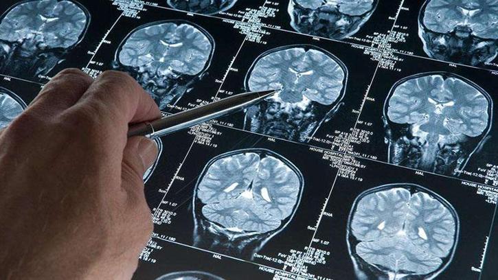 Araştırma: Alzheimer düşünüldüğünden daha erken başlayabilir
