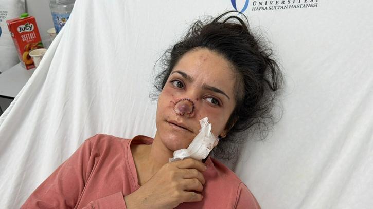 Eşi tarafından burnu ısırılıp koparılan İmran: Canımın acıyla balkondan atlamayı bile düşündüm