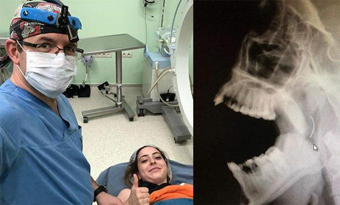 3 yaşında ameliyatta unutulan iğne 18 yıl sonra çıkartıldı