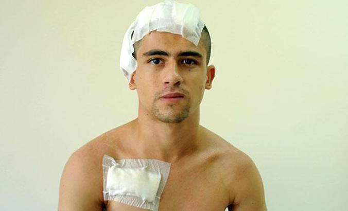 Distoniden beyin pili ile kurtuldu