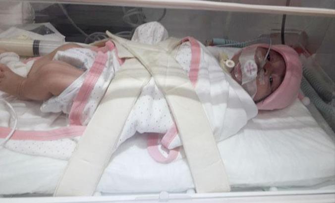 Dicle bebek, Ankara'da lazer tedavisi görecek