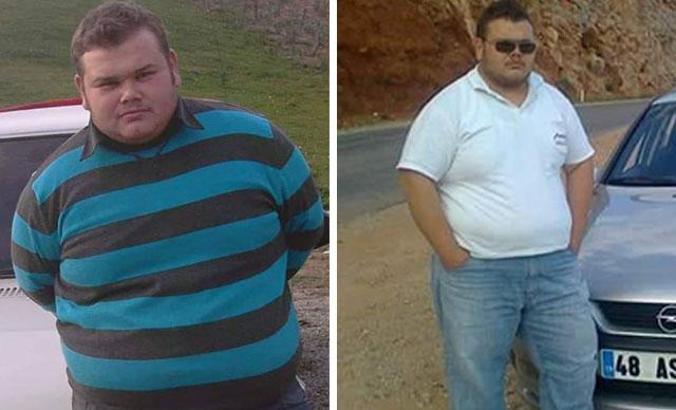 Tüp mide ameliyatından 1 ay sonra öldü