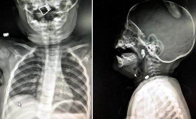 Boğazına mandal yayı kaçan bebek kurtarıldı