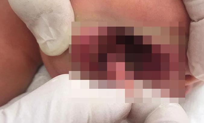 'Çift dilli' doğan Zeynep bebeğin ikinci dili ameliyatla alındı