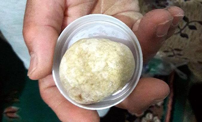 Mesanesinden çıkan taş doktorları bile hayrete düşürdü