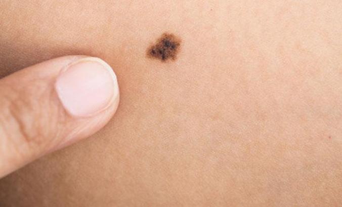 Dikkat! Uzmanlardan önemli uyarı: Malign Melanom, ölüm oranlarını yüzde 44 arttırıyor