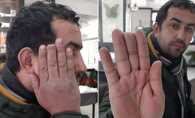 Hakimlik kopan parmak soruşturmasını tekrar açtı