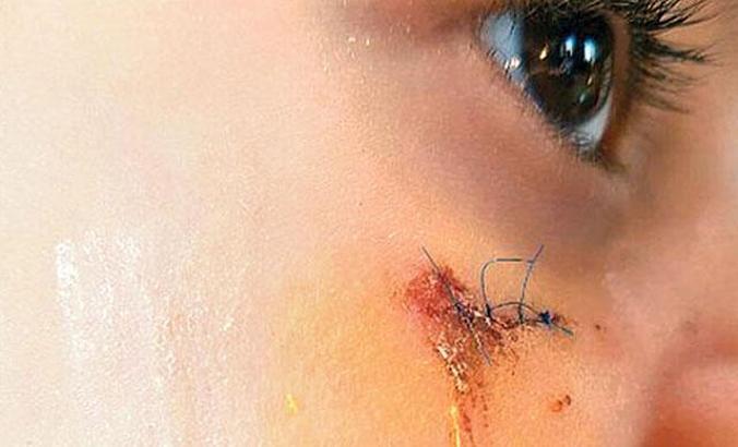 Rapor belli oldu... Yüzündeki kitap izi kalıcı