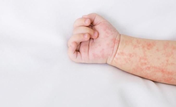 Yenidoğan bebeklerde en sık görülen cilt döküntüleri