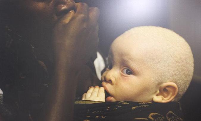 ‘Kara Kıtanın Beyaz Çocukları’: Afrikalı albinoların dramı sanatseverlerle buluştu