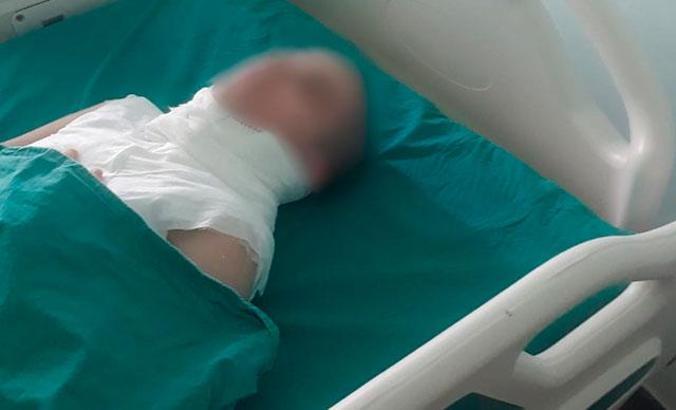 Üvey annesi tarafından yakıldığı öne sürülen kız 4. ameliyatını oldu