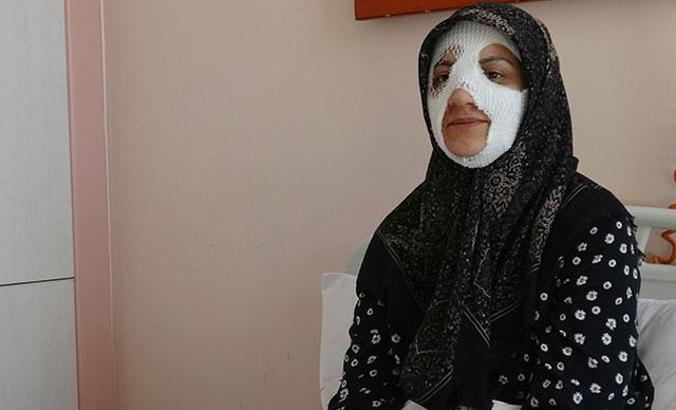 Suyun altına tuttuğu düdüklü tencere patladı, yüzü yandı