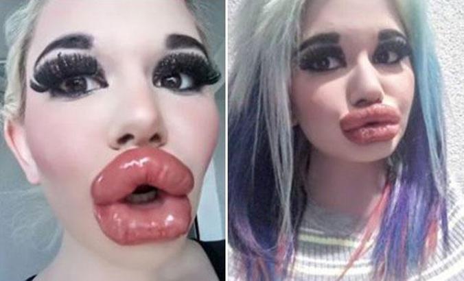 Bulgaristan'da genç kız Barbie’ye özenip 20’den fazla dudak dolgusu yaptırdı