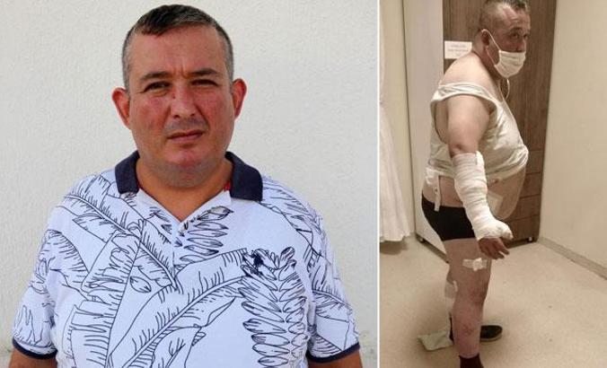 Oteldeki pitbull'ların saldırısına uğradı, 40 dikiş atılıp, 100 iğne yapıldı