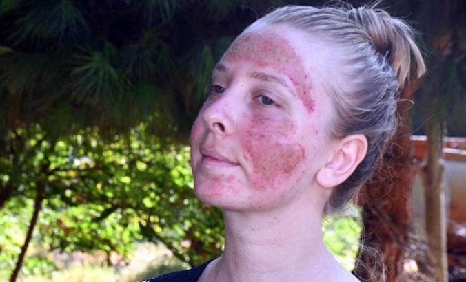 Cilt bakımı yaptırırken yüzünde yanıklar oluşan Müge, 6 ay tedavi görecek