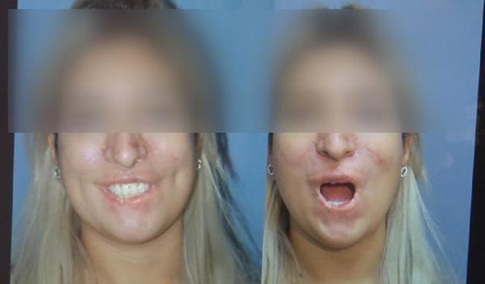 Estetik cerrahı Prof. Özmen : Botoks değil, yasaklanması gereken kalıcı dolgu maddeleri öldürüyor