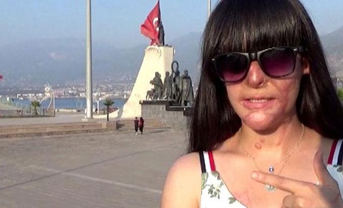 Yüzüne asit atan saldırganı affeden Berfin: Bu karardan çok pişmanlık duydum