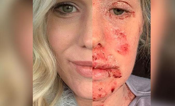 Egzama için kullandığı krem, tüm vücudunda yara çıkmasına neden oldu
