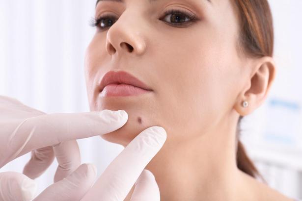 “Yeni oluşan benler cilt kanserinin belirtisi olabilir”