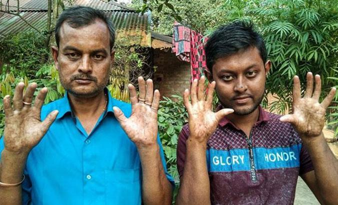 Bangladeş’te parmak izi olmayan aile görenleri şaşkına çevirdi