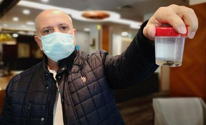 Kanser sandılar, biyopsi bile yapıldı;akciğerinden 32 yıl sonra çam fıstığı çıktı