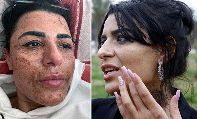 Güzellik merkezinde yüzü yanan Aslı: Sosyal medyadaki reklamlarına kandım