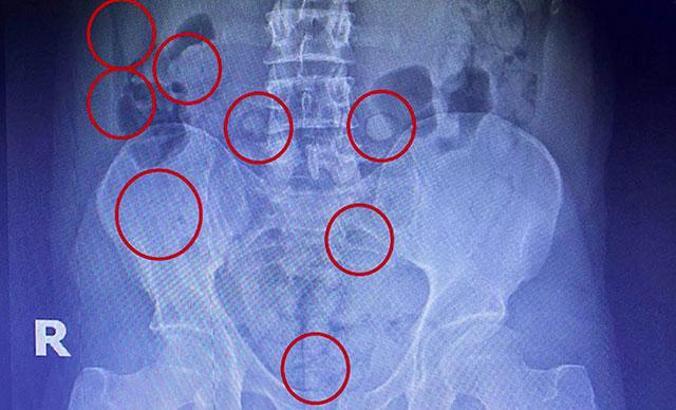 İranlının mide ve bağırsağındaki uyuşturucu röntgende ortaya çıktı
