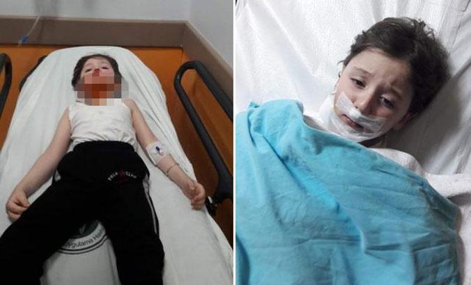 Küçük Bedirhan, sokak köpeklerinin saldırısında yaralandı