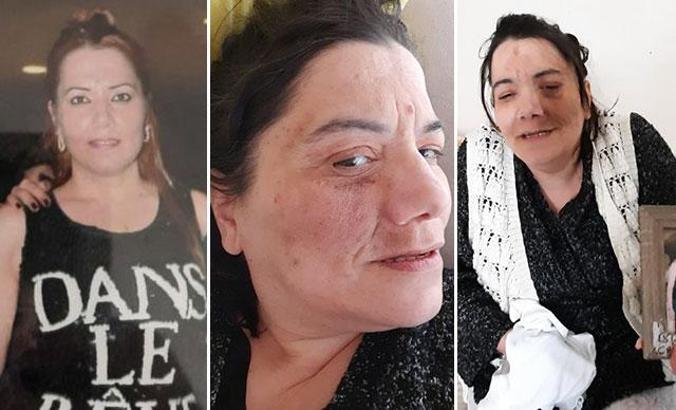 Damak tedavisinde sinir kesilince yüz felci oldu