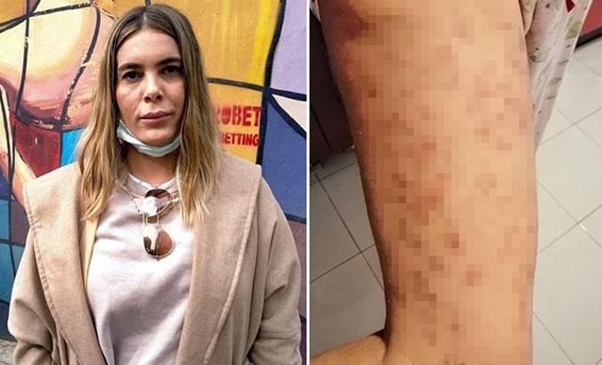 Lazer epilasyonda bacaklarında 'yanık oluştuğu' iddiasıyla şikayetçi oldu