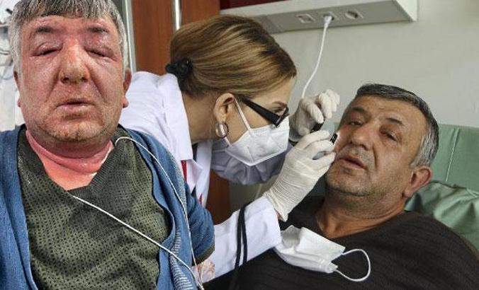 Yüzüne sürdüğü dezenfektan hastanelik etti