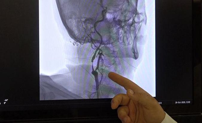 'Kan sulandırıcı kullanan hastalarda beyin kanaması, ölümcül netice verebilir'