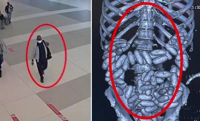 Havalimanında Nijerya uyruklu yolcunun midesinden bin 844 gram kokain ele geçirildi