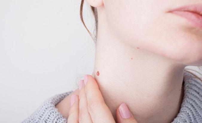 Her siğil kansere neden olmaz