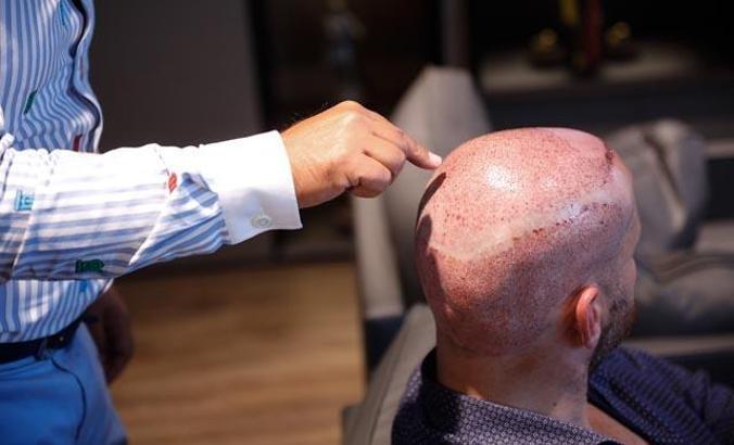 Saç ekimi için en çok Almanya'dan geliyorlar