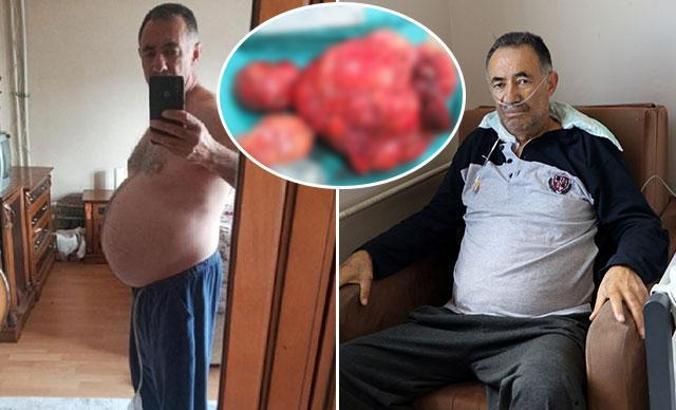 Kilo şikayetiyle hastaneye gitti, karnından 35 kilo tümör çıkarıldı
