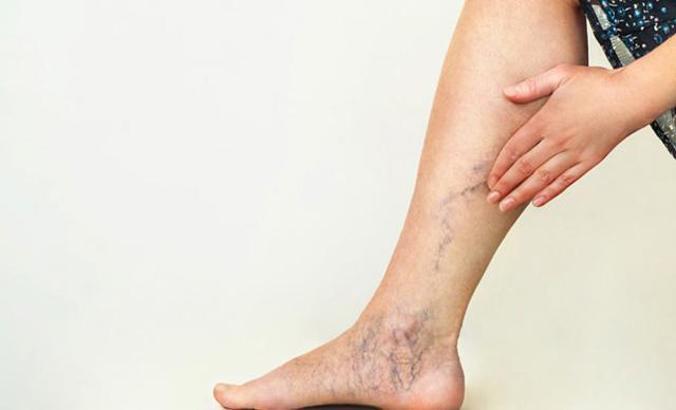 “Problem of varicose veins can be solved to 99 percent with painless laser treatment”