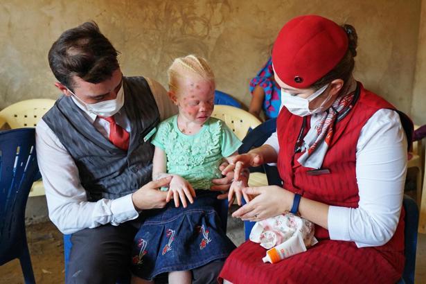 THY, güneşten saklanan albino hastası çocukların yaralarına merhem oldu