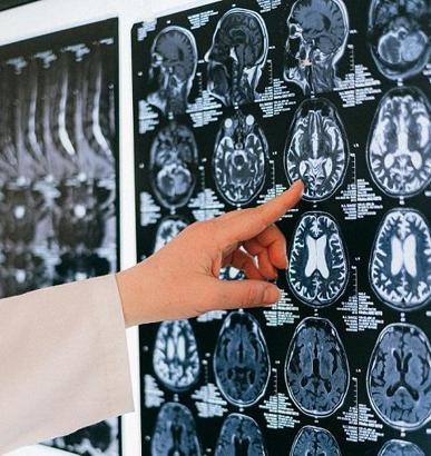 Serebral palsi; çocuklarda ilk 3 yaşa dikkat