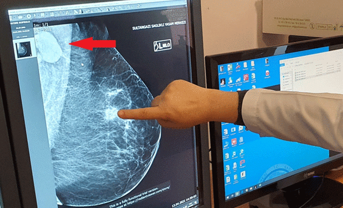 Radyoloji Uzmanı Yrd. Doç. Dr. İkizceli: Aşılamaya bağlı tek taraflı lenf bezi tutulumu, meme kanseriyle karışabilir