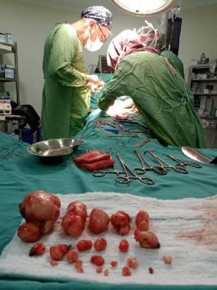 Ağrı şikayetiyle gittiği hastanede, rahim duvarından 23 miyom çıkarıldı