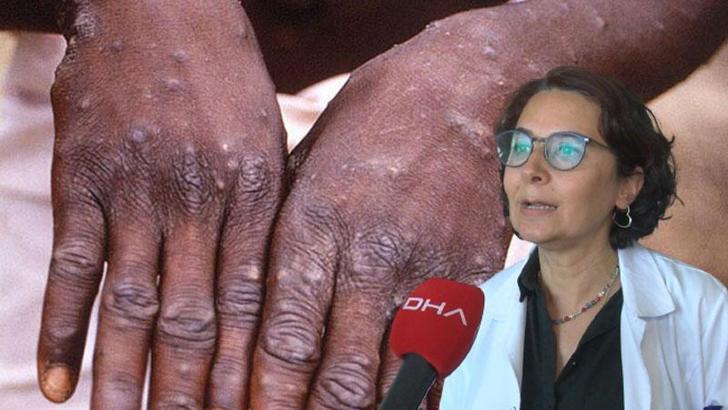 Prof. Dr. Yavuz: Maymun çiçeğinde ilk vaka tespit edildiğinde karantina 28 gün sürebilir