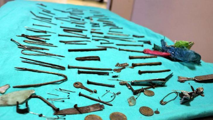 Nails, knives, tweezers: 158 pieces of metal were removed from the stomach of a woman