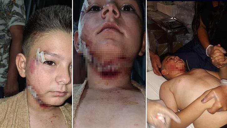 Sahipsiz köpeğin saldırdığı çocuğa 40 dikiş atıldı